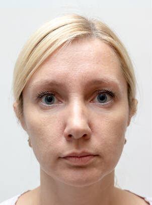 Woman face with wrinkles and age change before and after treatment - the result of rejuvenating cosmetological procedures of biorevitalization, face lifting and pigment spots removal.