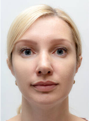 Woman face with wrinkles and age change before and after treatment - the result of rejuvenating cosmetological procedures of biorevitalization, face lifting and pigment spots removal.