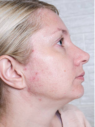 Young woman before and after anti acne treatment, skincare and dermatology concept.