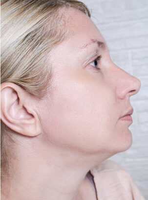 Young woman before and after anti acne treatment, skincare and dermatology concept.