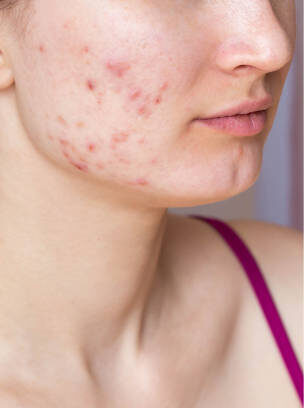 Cropped shot of young woman's face before and after acne treatment on face. Pimples, red scars on the cheeks and chin of a girl. Problem skin, health care and beauty concept. Dermatology, cosmetology