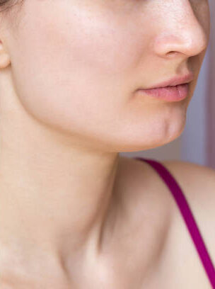 Cropped shot of young woman's face before and after acne treatment on face. Pimples, red scars on the cheeks and chin of a girl. Problem skin, health care and beauty concept. Dermatology, cosmetology